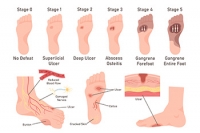 Management of Diabetic Foot Ulcers