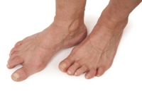 Rheumatoid Arthritis and the Feet