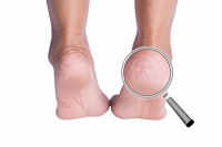 Reasons and Treatment for Cracked Heels